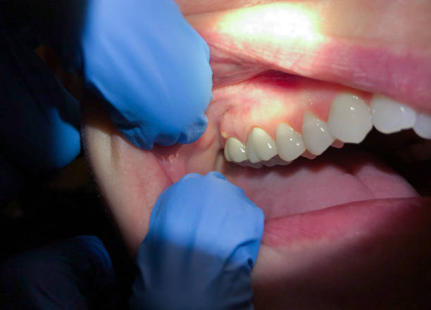 Urgent Tooth Repair in IN